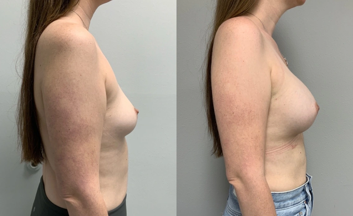 breast Aug side