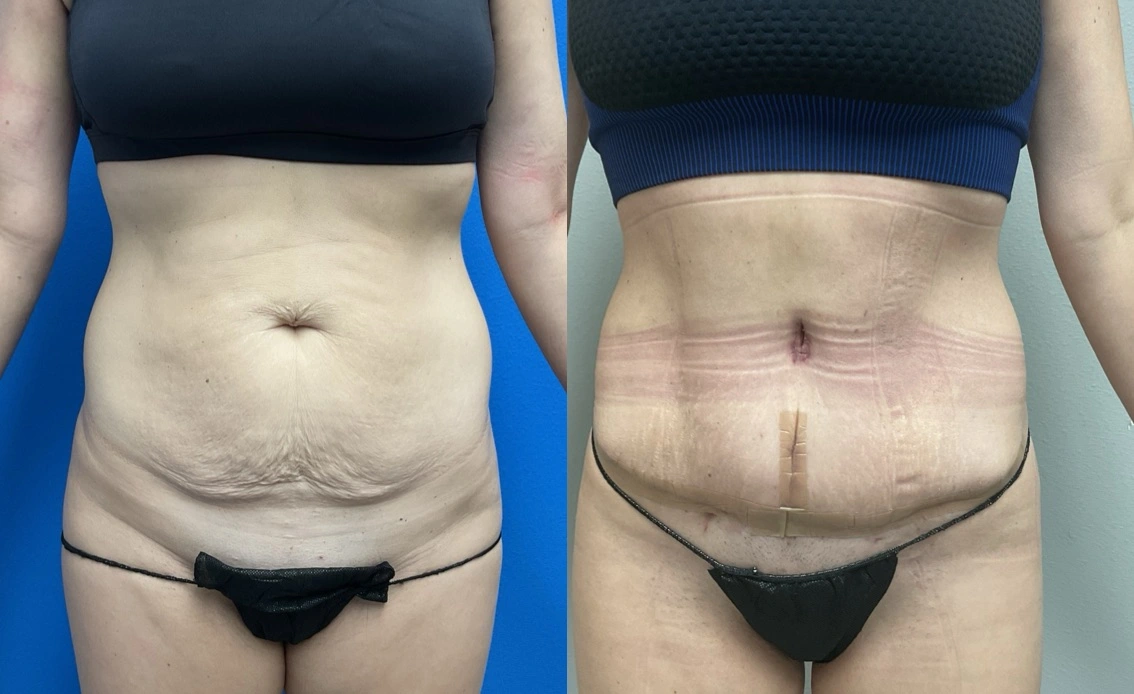 4 weeks post op- tummy tuck