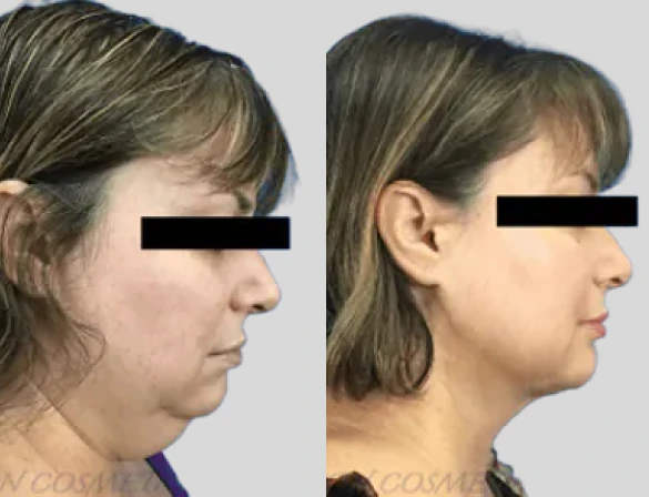 What is a Neck Liposuction
