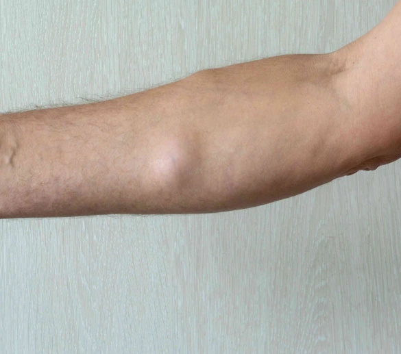 About Lipoma Removal Banner