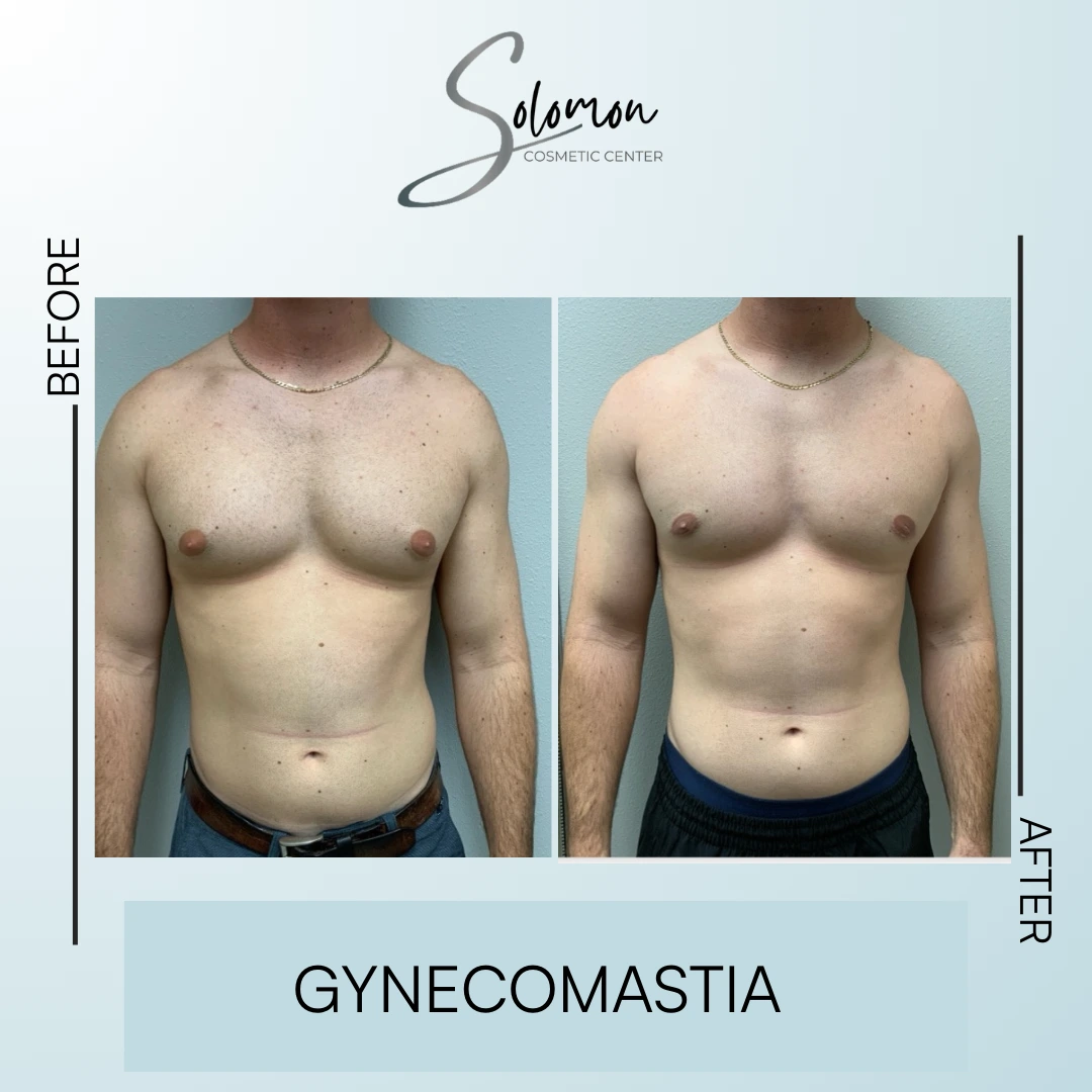 Gynecomastia Before and After Results Banner