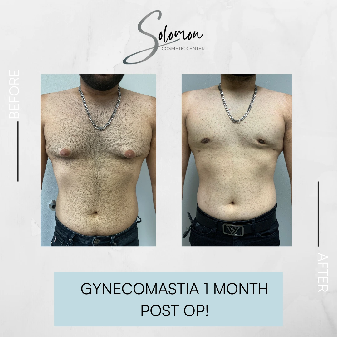 Gynecomastia Before and After Results Banner