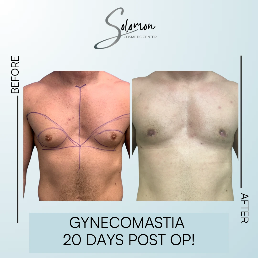 Gynecomastia Before and After Results Banner
