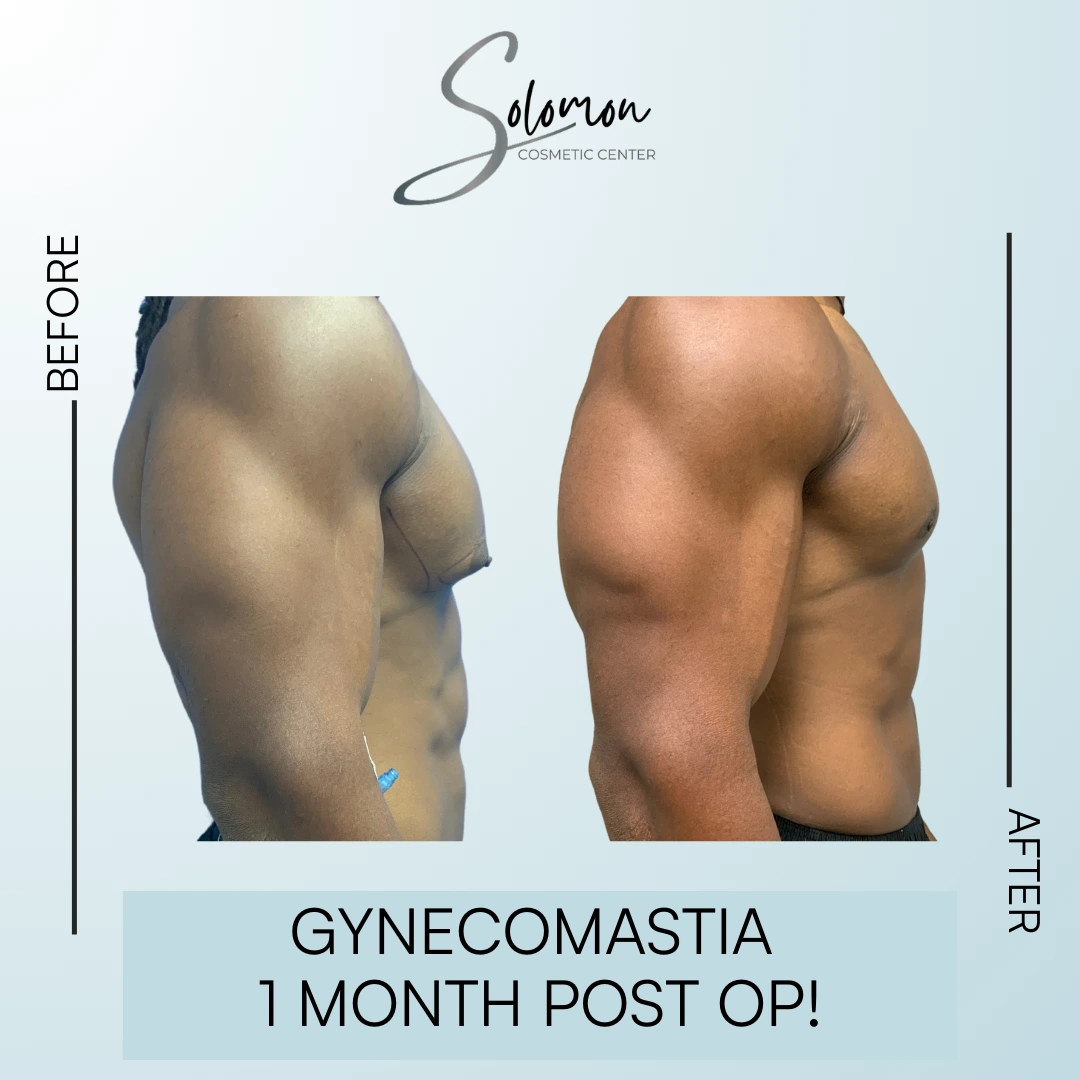 Gynecomastia Before and After Results Banner