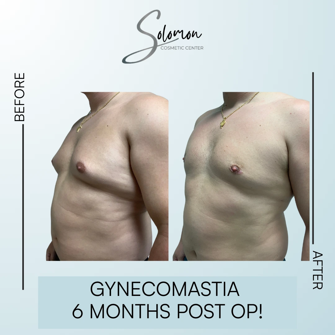 Gynecomastia Before and After Results Banner