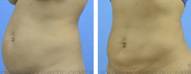 Liposuction: Before and After Gallery