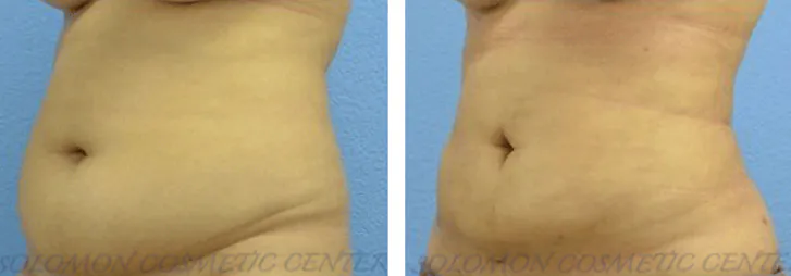 Liposuction: Before and After Gallery