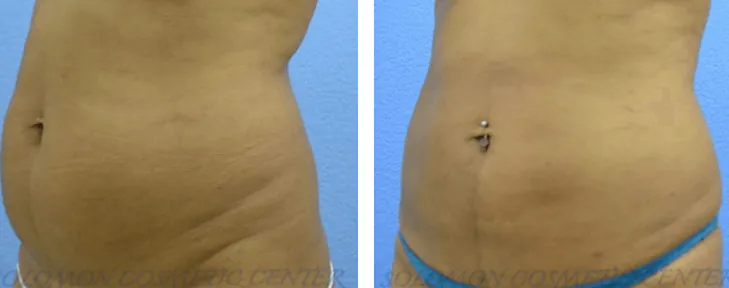 Liposuction: Before and After Gallery