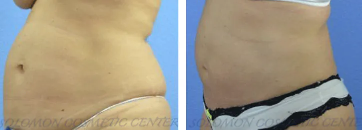 Liposuction: Before and After Gallery