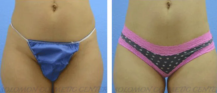 Liposuction: Before and After Gallery