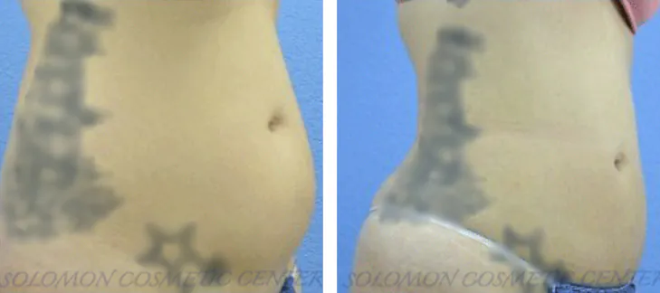 Liposuction: Before and After Gallery