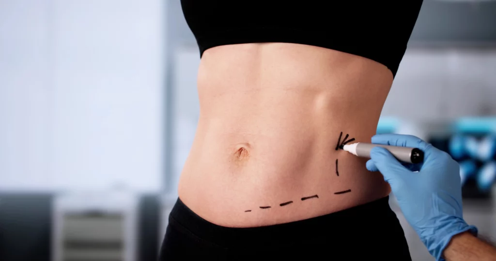 The Top 5 Most Popular Liposuction Areas and Why They Work? Banner